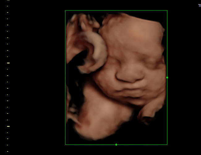 3D ultrasound image at 29 weeks
